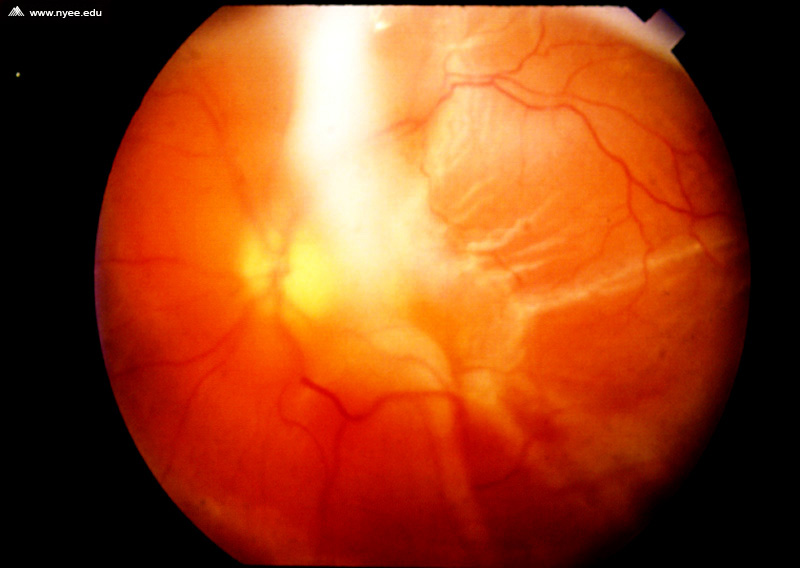 Proliferative Vitreoretinopathy Nyee 1776